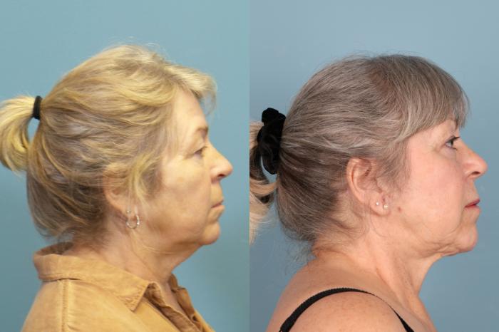 Before & After Face Lift Case 388 Right Side View in Portland, OR