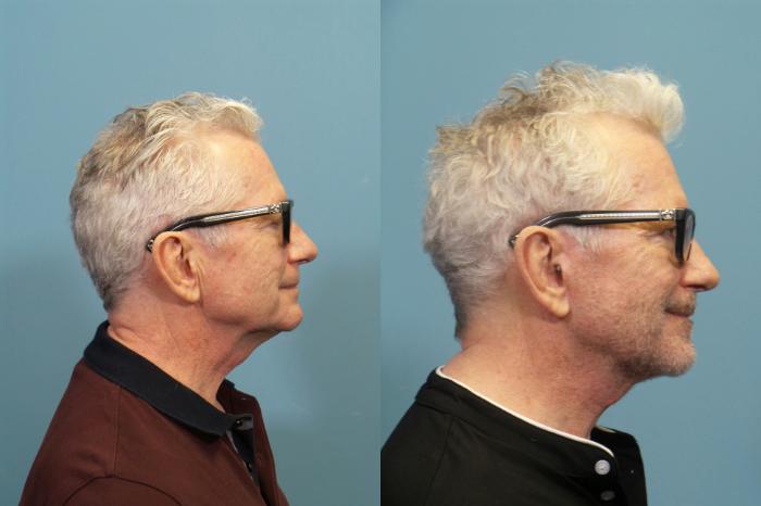 Before & After Face Lift Case 389 Right Side View in Portland, OR
