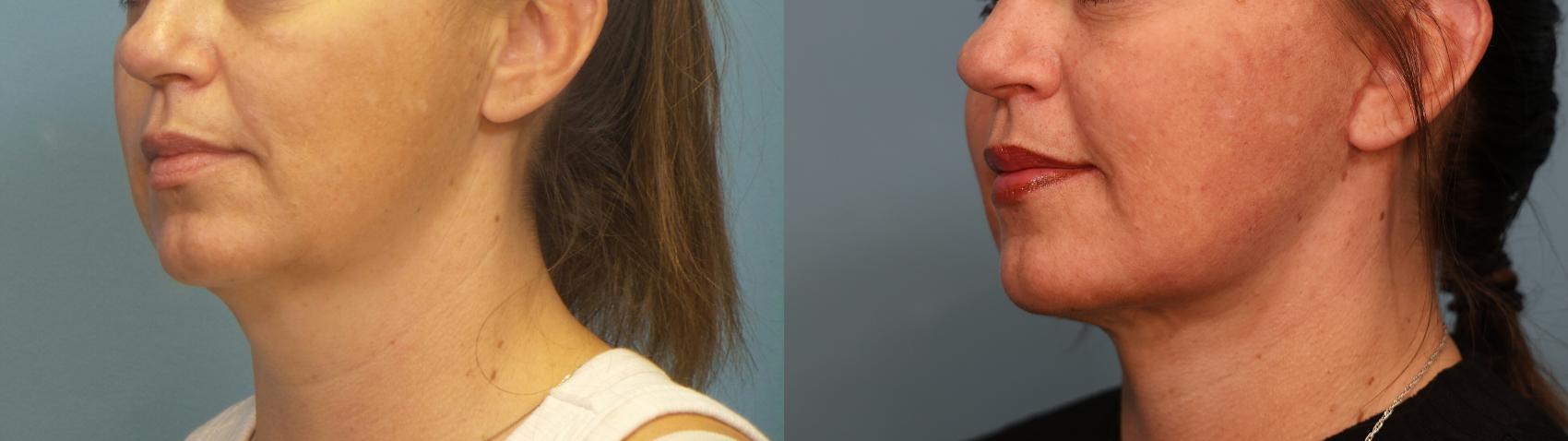 Before & After Face Lift Case 400 Left Oblique View in Portland, OR