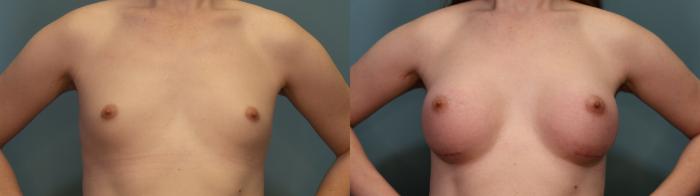 Before & After Gender Affirming Breast Augmentation Case 308 Front View in Portland, OR