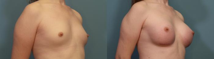 Before & After Gender Affirming Breast Augmentation Case 308 Right Oblique View in Portland, OR