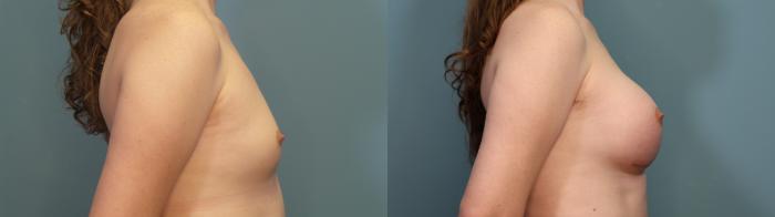 Before & After Gender Affirming Breast Augmentation Case 308 Right Side View in Portland, OR