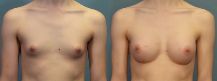 Before & After Gender Affirming Breast Augmentation Case 312 Front View in Portland, OR
