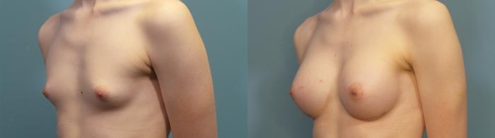 Before & After Gender Affirming Breast Augmentation Case 312 Left Oblique View in Portland, OR