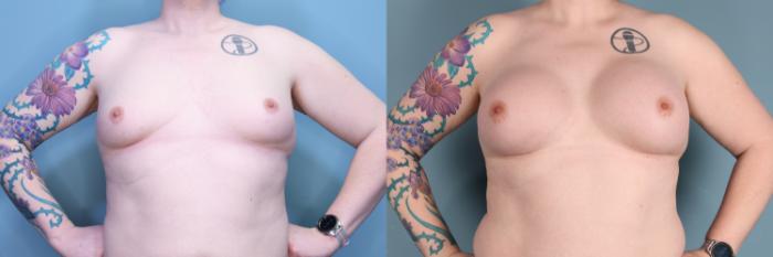 Before & After Gender Affirming Breast Augmentation Case 381 Front View in Portland, OR
