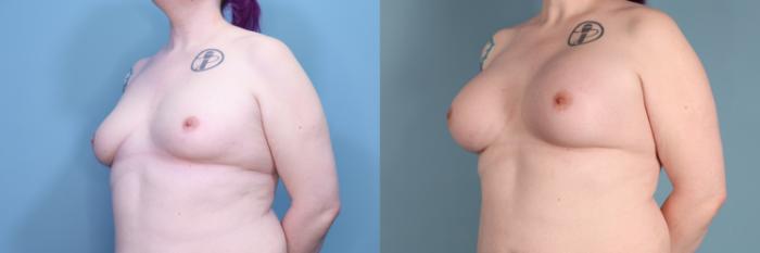 Before & After Gender Affirming Breast Augmentation Case 381 Left Oblique View in Portland, OR