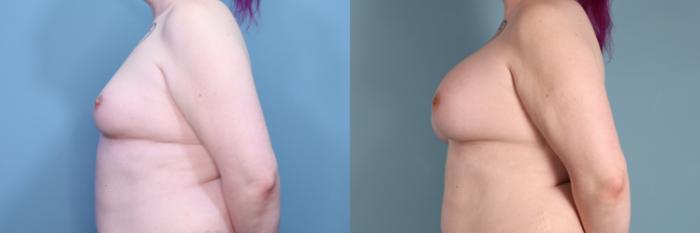 Before & After Gender Affirming Breast Augmentation Case 381 Left Side View in Portland, OR