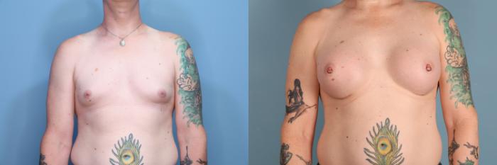 Before & After Gender Affirming Breast Augmentation Case 427 Front View in Portland, OR