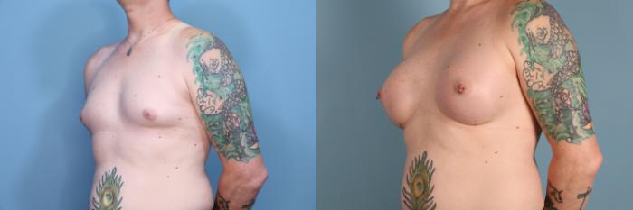 Before & After Gender Affirming Breast Augmentation Case 427 Left Oblique View in Portland, OR