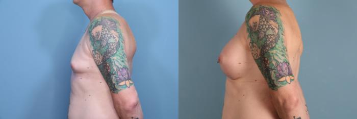Before & After Gender Affirming Breast Augmentation Case 427 Left Side View in Portland, OR