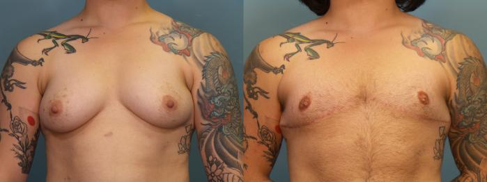 Before & After Gender Affirming Top Surgery Case 328 Front View in Portland, OR