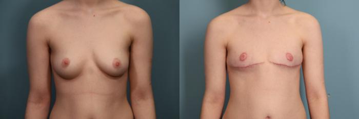 Before & After Gender Affirming Top Surgery Case 375 Front View in Portland, OR