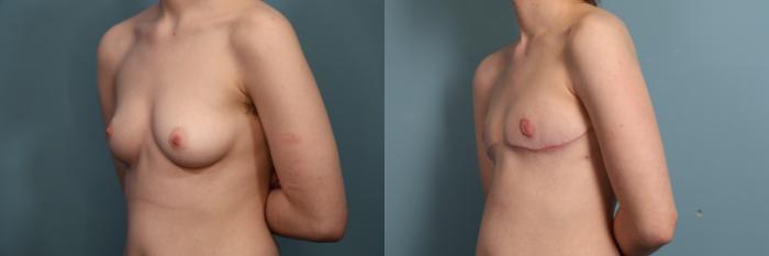 Before & After Gender Affirming Top Surgery Case 375 Left Side View in Portland, OR