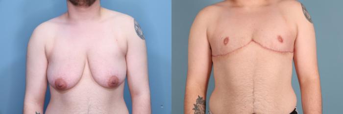 Before & After Gender Affirming Top Surgery Case 383 Front View in Portland, OR