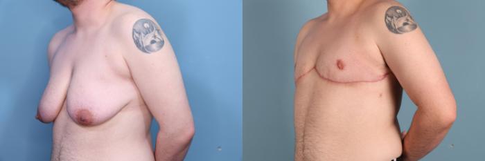 Before & After Gender Affirming Top Surgery Case 383 Left Side View in Portland, OR