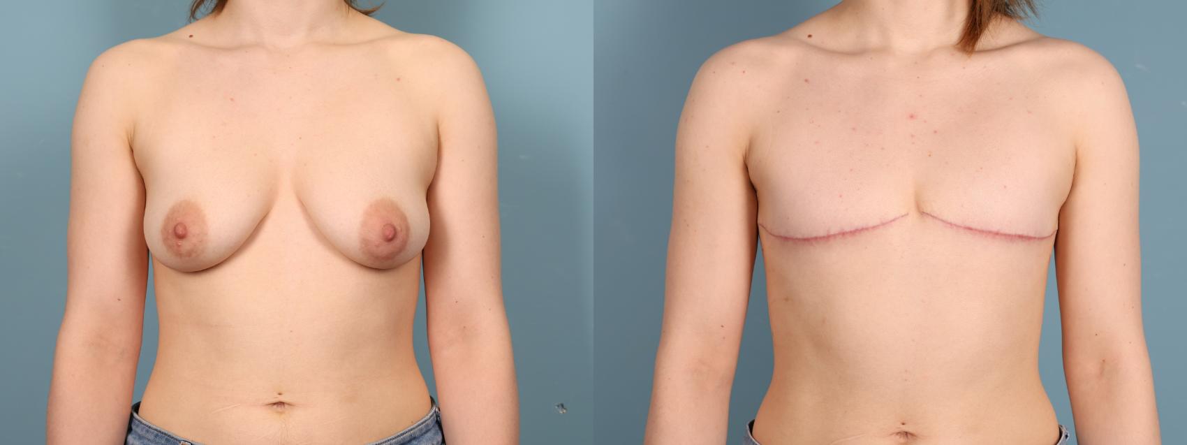 Before & After Gender Affirming Top Surgery Case 395 Front View in Portland, OR