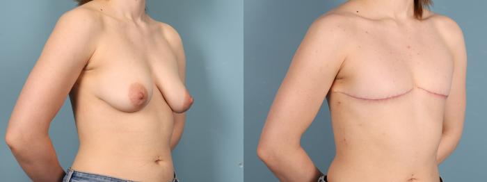 Before & After Gender Affirming Top Surgery Case 395 Right Oblique View in Portland, OR