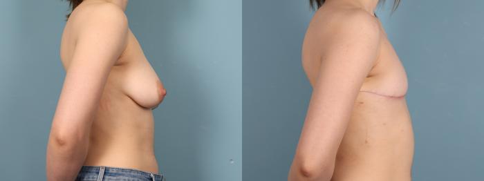 Before & After Gender Affirming Top Surgery Case 395 Right Side View in Portland, OR