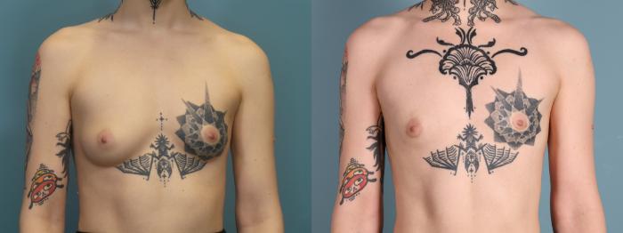 Before & After Gender Affirming Top Surgery Case 396 Front View in Portland, OR
