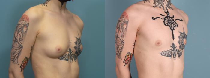 Before & After Gender Affirming Top Surgery Case 396 Right Oblique View in Portland, OR