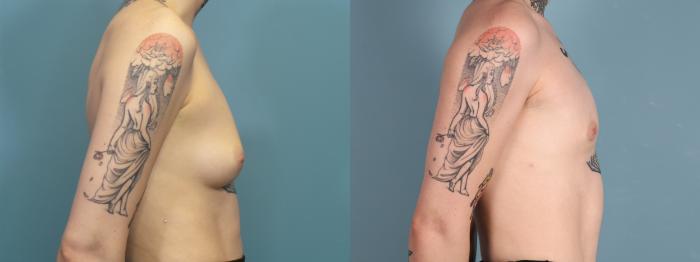 Before & After Gender Affirming Top Surgery Case 396 Right Side View in Portland, OR
