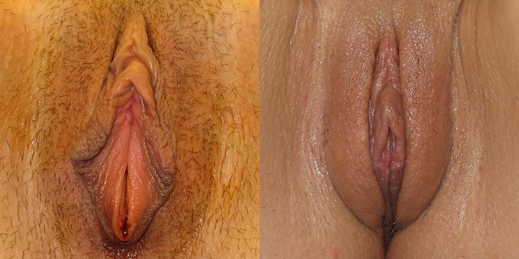 Before & After Labiaplasty Case 260 View #1 View in Portland, OR