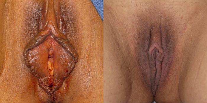Before & After Labiaplasty Case 261 View #2 View in Portland, OR