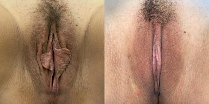 Before & After Labiaplasty Case 265 View #1 View in Portland, OR