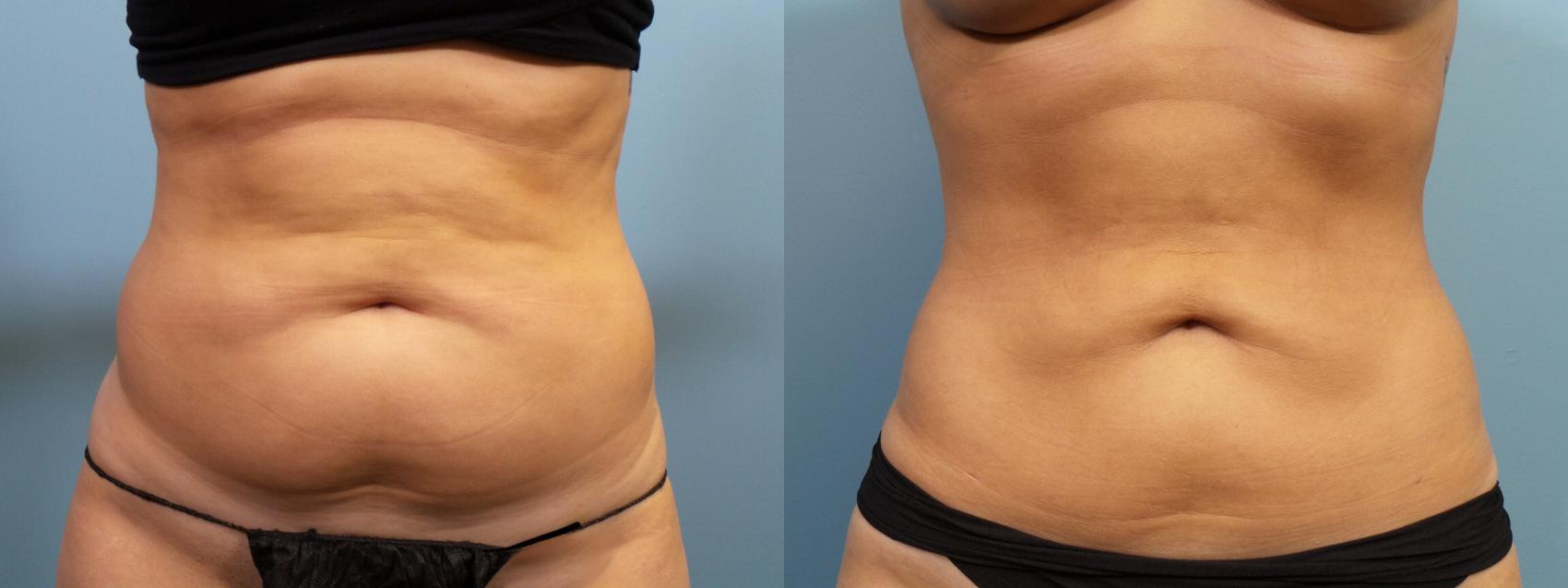 Before & After Liposuction Case 125 View #1 View in Portland, OR