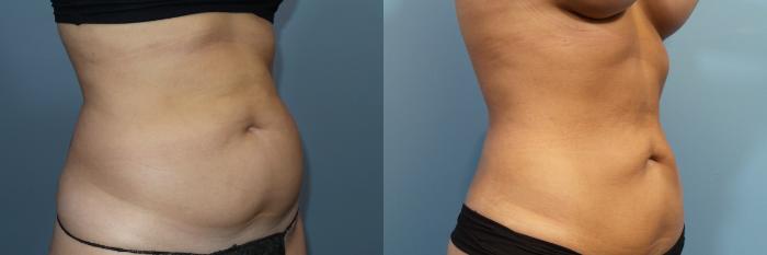 Before & After Liposuction Case 125 View #2 View in Portland, OR