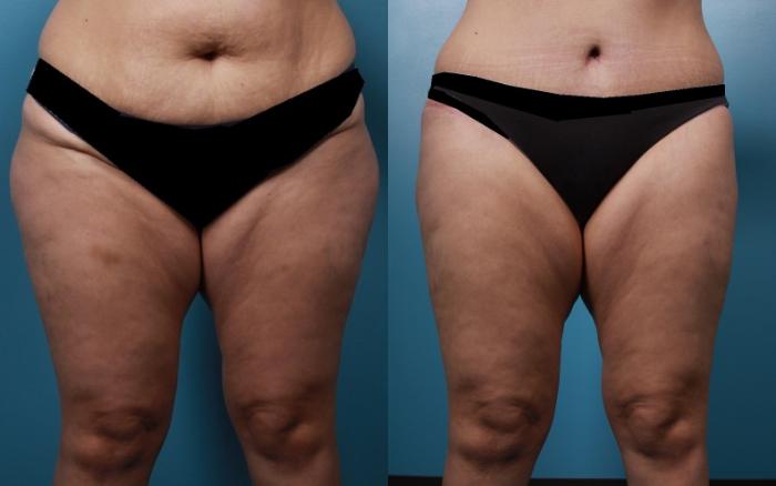 Before & After Tummy Tuck (Abdominoplasty) Case 22 View #1 View in Portland, OR