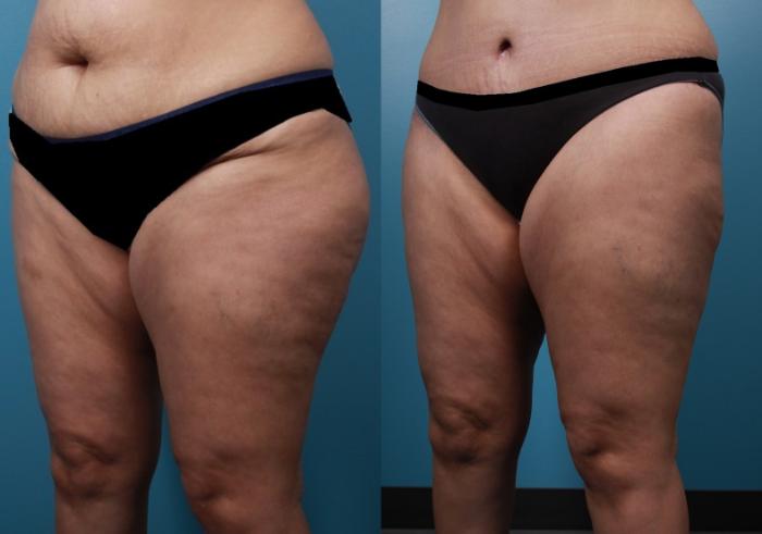 Before & After Liposuction Case 22 View #2 View in Portland, OR