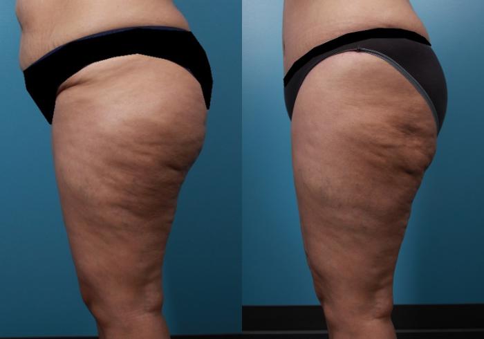 Before & After Liposuction Case 22 View #3 View in Portland, OR