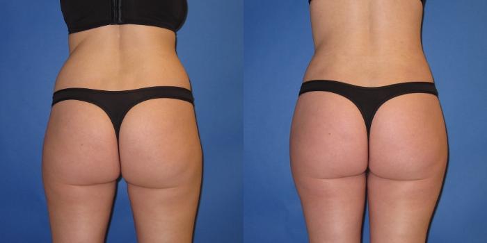 Before & After Liposuction Case 246 View #1 View in Portland, OR