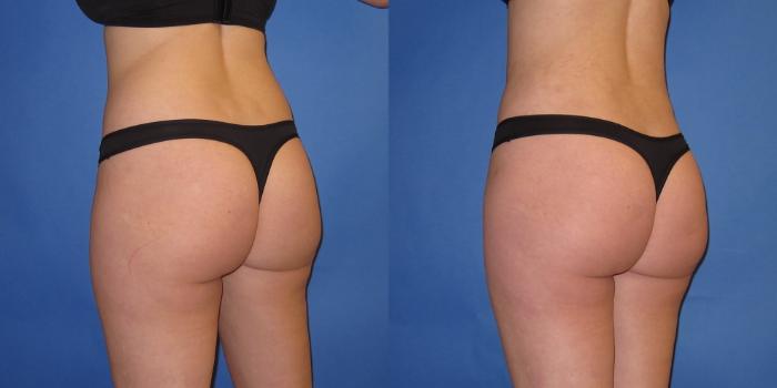 Before & After Liposuction Case 246 View #2 View in Portland, OR