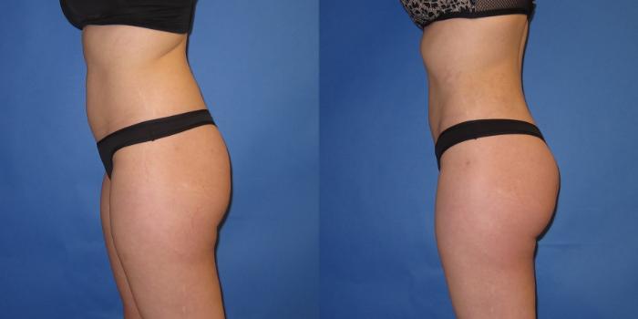 Before & After Liposuction Case 246 View #3 View in Portland, OR