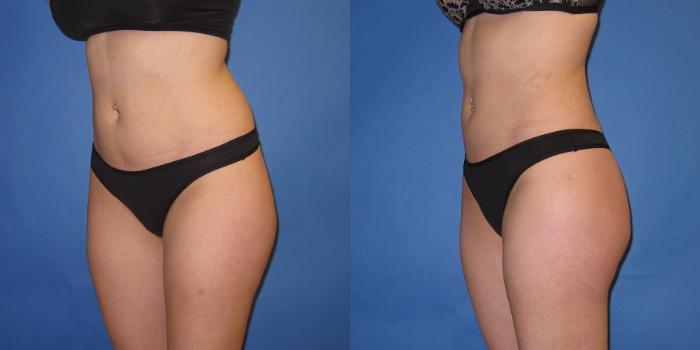 Before & After Liposuction Case 246 View #4 View in Portland, OR