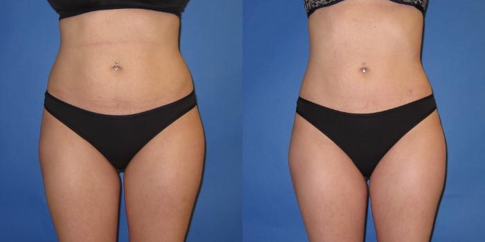 Before & After Liposuction Case 246 View #5 View in Portland, OR