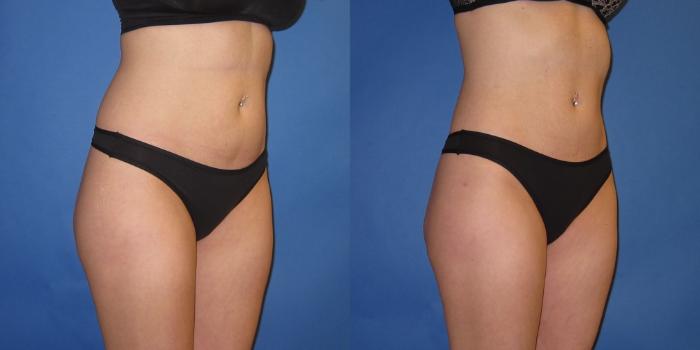 Before & After Liposuction Case 246 View #6 View in Portland, OR