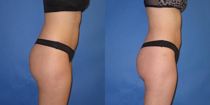 Before & After Liposuction Case 246 View #7 View in Portland, OR