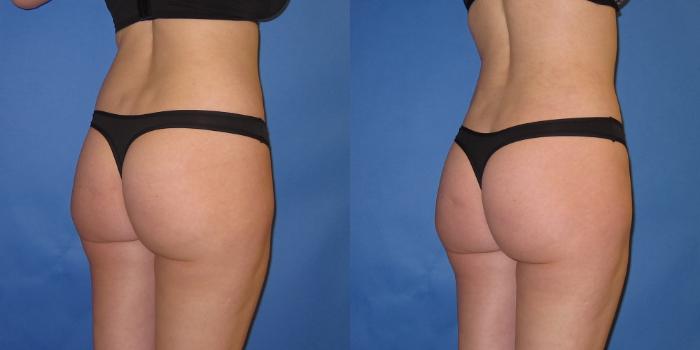 Before & After Liposuction Case 246 View #8 View in Portland, OR
