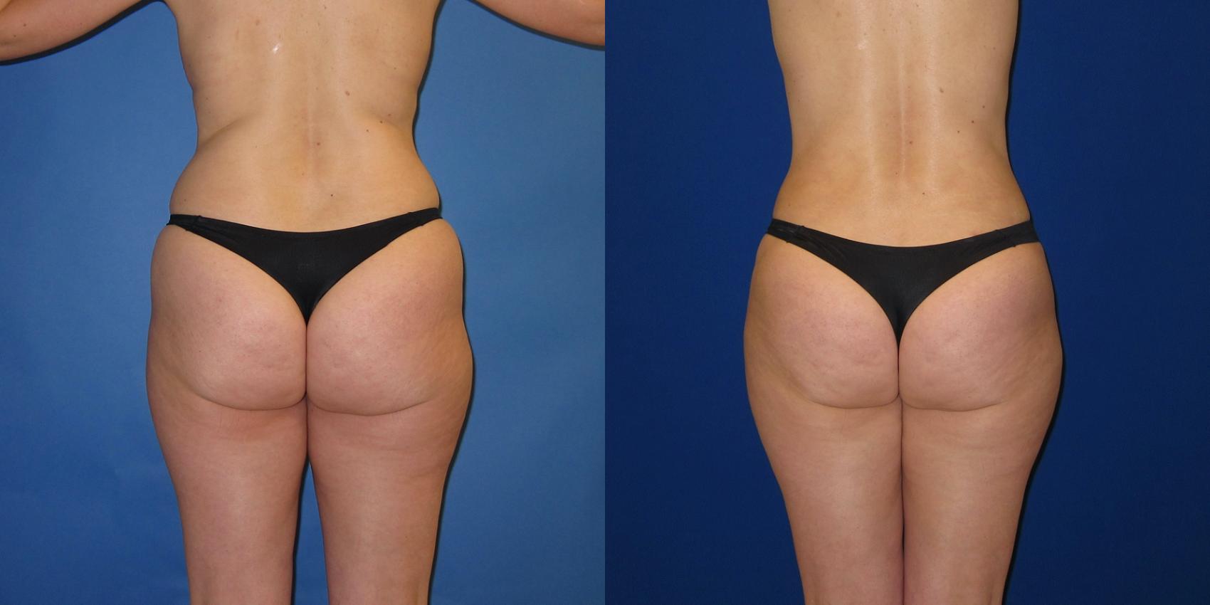 Before & After Liposuction Case 247 View #1 View in Portland, OR