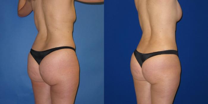 Before & After Liposuction Case 247 View #2 View in Portland, OR