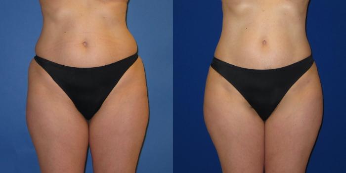 Before & After Liposuction Case 247 View #3 View in Portland, OR