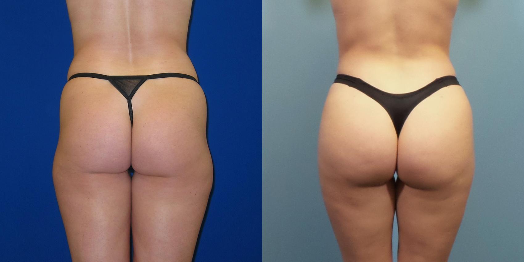 Before & After Liposuction Case 249 View #1 View in Portland, OR