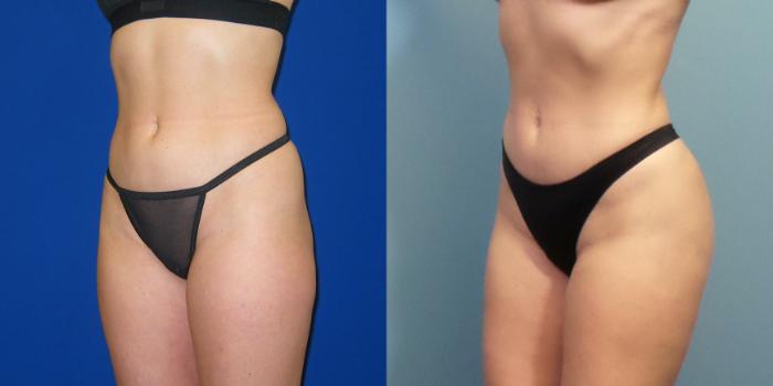Before & After Liposuction Case 249 View #2 View in Portland, OR