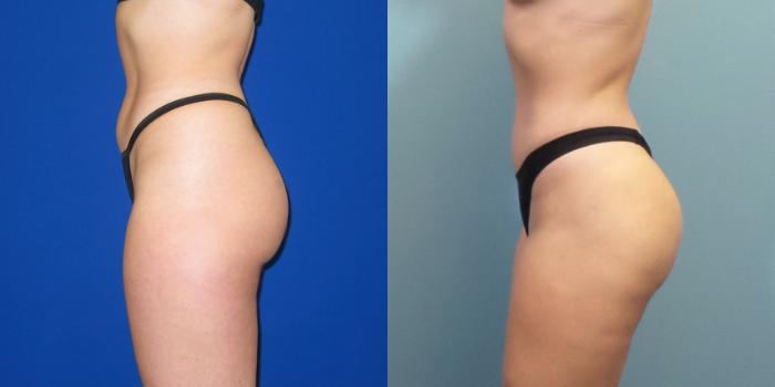 Before & After Liposuction Case 249 View #3 View in Portland, OR