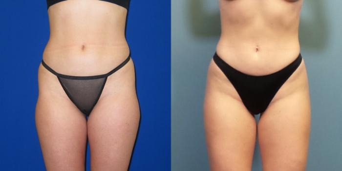 Before & After Liposuction Case 249 View #4 View in Portland, OR