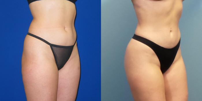 Before & After Liposuction Case 249 View #5 View in Portland, OR