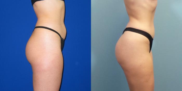 Before & After Liposuction Case 249 View #6 View in Portland, OR